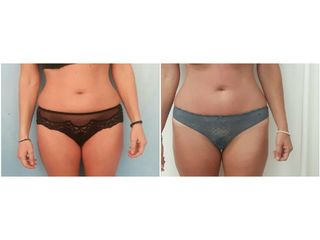 liposuzione prima dopo