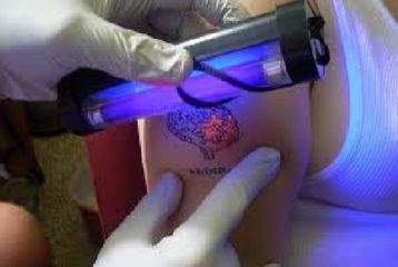 Depigmentazione tatoo