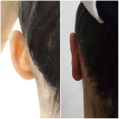 correzione orecchie a ventola