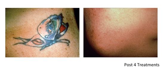 Rimozione tatuaggi prima e dopo