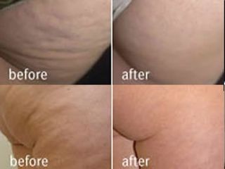 Trattamento cellulite prima e dopo