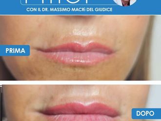 Filler labbra prima e dopo - 878853