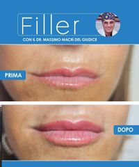 Dott. Massimo Macrì Del Giudice Filler labbra