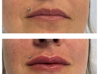 Filler labbra prima e dopo - 869525
