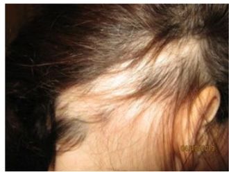 Alopecia prima e dopo - 876690