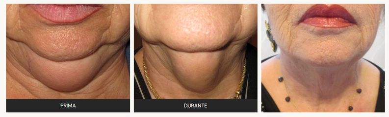 Dott.ssa Solomon Lia doppio mento