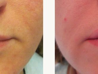 Filler labbra prima e dopo - 876813