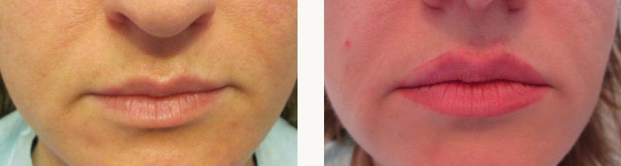 Dott.ssa Solomon Lia Filler Labbra