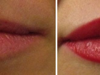 Filler labbra prima e dopo - 876814