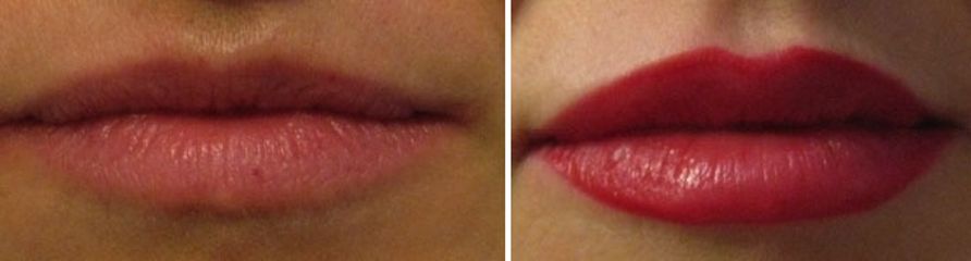 Dott.ssa Solomon Lia Filler Labbra