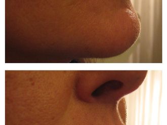 Filler labbra prima e dopo - 876815