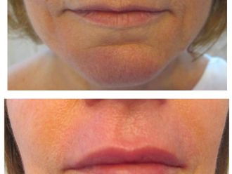 Filler labbra prima e dopo - 876816