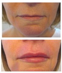 Dott.ssa Solomon Lia Filler Labbra