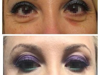 Eliminare occhiaie prima e dopo - 876817