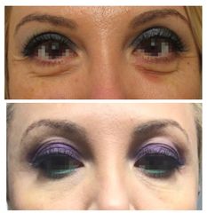 Dott.ssa Solomon Lia occhiaie e zona perioculare