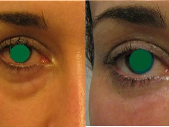 Eliminare occhiaie prima e dopo - 876818