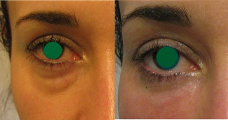 Dott.ssa Solomon Lia occhiaie e zona perioculare