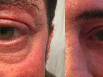 Eliminare occhiaie prima e dopo - 876819