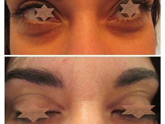 Eliminare occhiaie prima e dopo - 876821