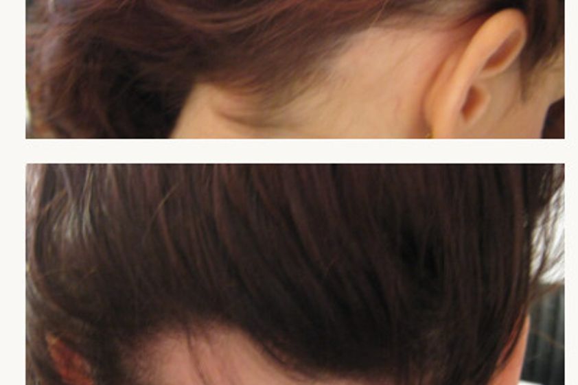 Alopecia prima e dopo - 876822