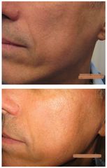 Dott.ssa Solomon Lia rimodellamento zigomi con acido ialuronico.jpg