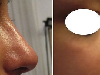 Rinofiller prima e dopo - 876824