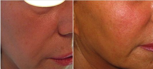 Dott.ssa Solomon Lia rimodellamento zigomi con acido ialuronico