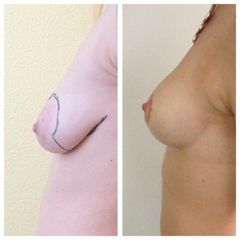 Mastopessi prima e dopo