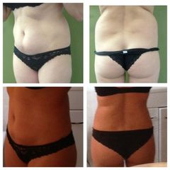 Liposcultura prima e dopo
