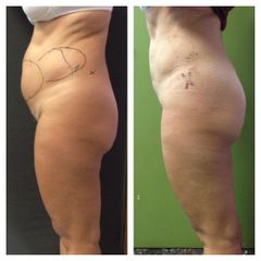 Liposcultura prima e dopo