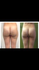 Liposcultura prima e dopo