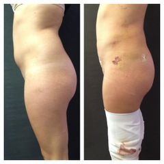 Liposcultura prima e dopo