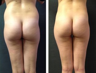 Liposcultura prima e dopo