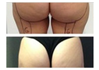 Liposcultura prima e dopo