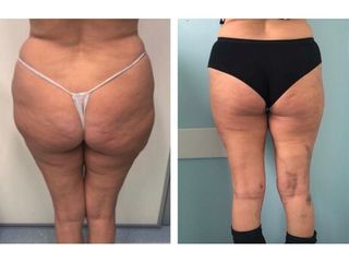 Liposuzione - Dott.ssa Francesca Mazzeo