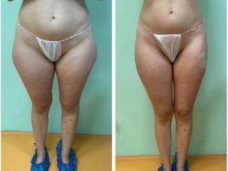 Liposuzione - Dott.ssa Francesca Mazzeo
