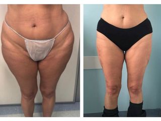 Liposuzione - Dott.ssa Francesca Mazzeo