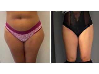 Liposuzione - Dott.ssa Francesca Mazzeo