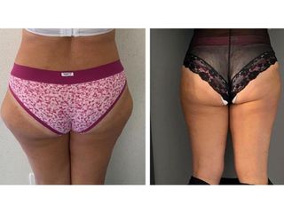 Liposuzione - Dott.ssa Francesca Mazzeo