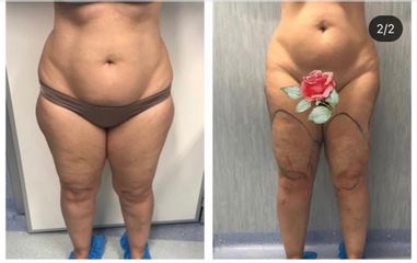 Liposuzione - Dott.ssa Francesca Mazzeo