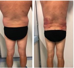 Liposuzione - Dott.ssa Francesca Mazzeo