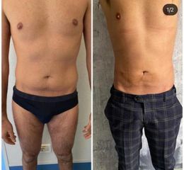 Liposuzione - Dott.ssa Francesca Mazzeo