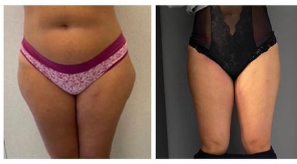 Liposuzione - Dott.ssa Francesca Mazzeo