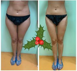 Liposuzione - Dott.ssa Francesca Mazzeo