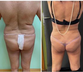 Liposuzione - Dott.ssa Francesca Mazzeo