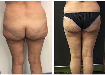 Liposuzione - Dott.ssa Francesca Mazzeo