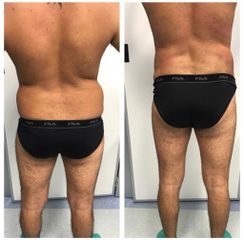 Liposuzione - Dott.ssa Francesca Mazzeo