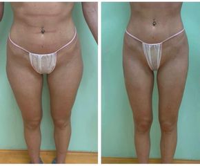 Liposuzione - Dott.ssa Francesca Mazzeo