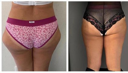 Liposuzione - Dott.ssa Francesca Mazzeo