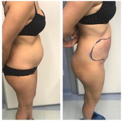 Liposuzione - Dott.ssa Francesca Mazzeo